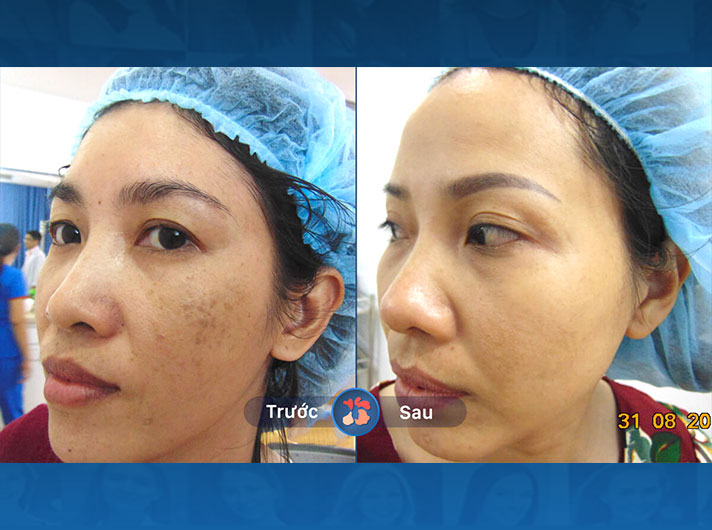 Ms.Minh - Da chị Minh trở nên sáng mịn và không còn những vết nám xấu xí nữa.