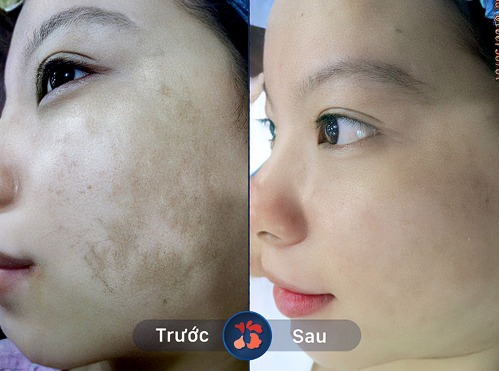 Ms.Thảo - Dịch vụ trị nám này đã giúp chị Thảo lấy lại sự tự tin về ngoại hình của mình