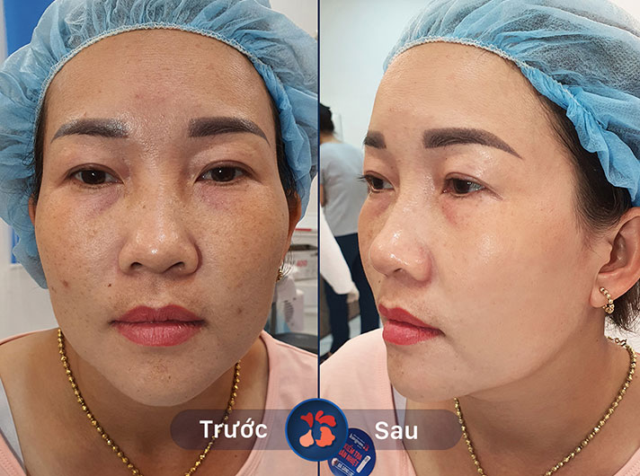 Ms.Thu Hương - Da chị Hường trở nên sáng mịn và không còn những vết nám xấu xí nữa. Bạn bè ai cũng khen da chị đẹp hơn trước rất nhiều