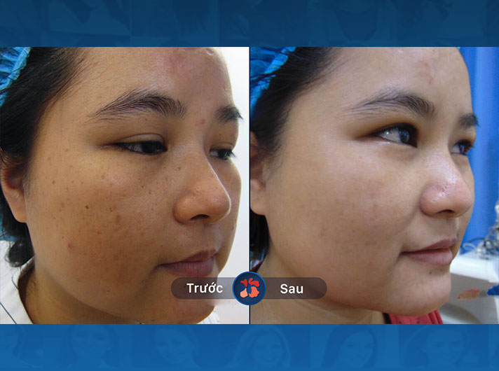 Ms.Hà - Dịch vụ trị nám này không chỉ hiệu quả mà còn rất an toàn và lành tính. Chị Hà hoàn toàn yên tâm khi lựa chọn