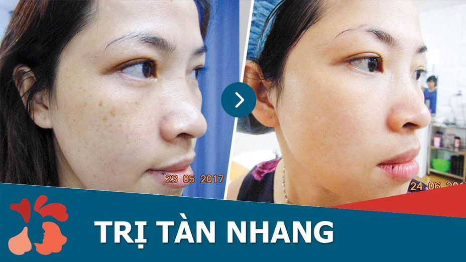 Kết quả sau một lần điều trị tàn nhang bằng Laser Toning