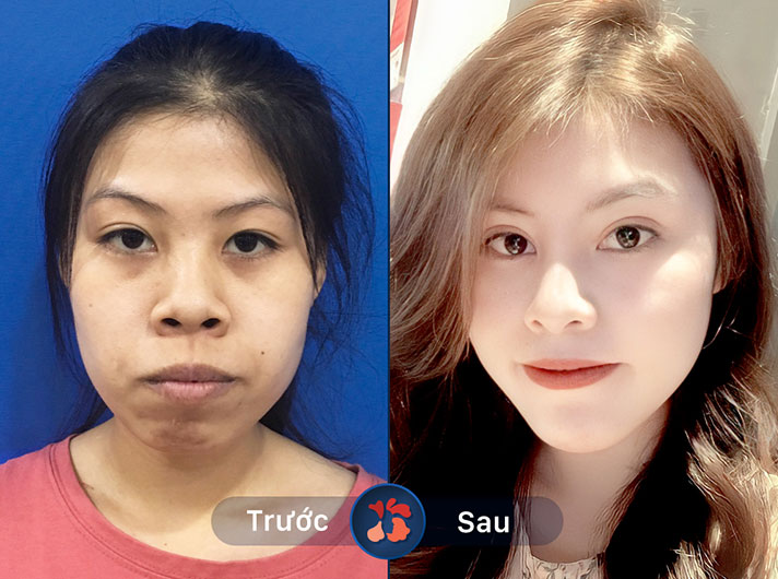 Ms.Nguyễn Thị Hoa - Sau khi làm hàm mặt, tôi cảm thấy khuôn mặt mình cân đối và thanh tú hơn rất nhiều