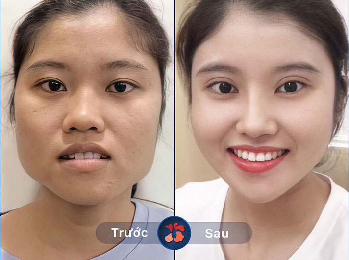 Ms.Phạm Thanh Hằng - Sau khi thẩm mỹ hàm mặt, gương mặt trở nên hài hòa và ưa nhìn hơn