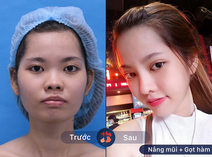 Ms.Vũ Thị Lan - Gương mặt khách hàng đã thay đổi rõ rệt, trở nên mềm mại và rõ các nét