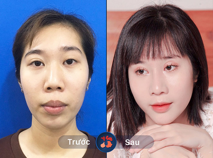 Ms.Lê Thị Nhung - Giờ đây chị Nhung có thể tự tin chụp ảnh mọi lúc