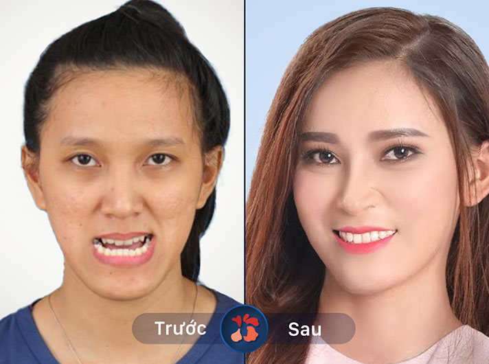 Ms.Trần Thị Ngọc Bích - Khuôn mặt giờ đây trở nên hài hòa và tươi tắn