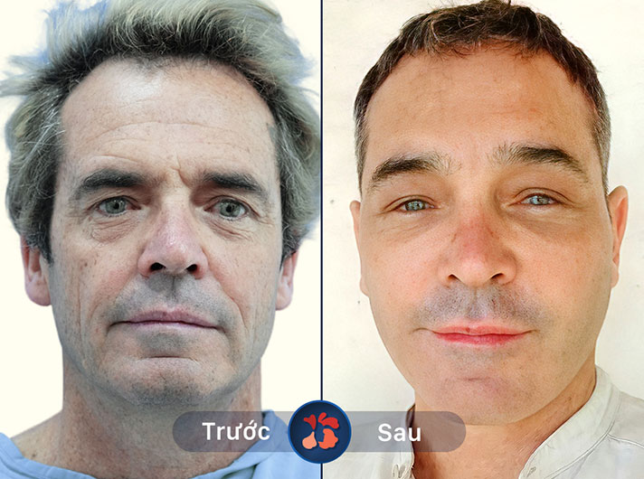 Mr.Thanh Tâm - Trông trẻ hơn hẳn sau khi sử dụng dịch vụ căng da