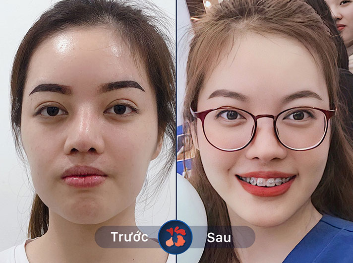 Ms.Hoàng Oanh - Da căng bóng, mềm mịn hơn rất nhiều sau liệu trình