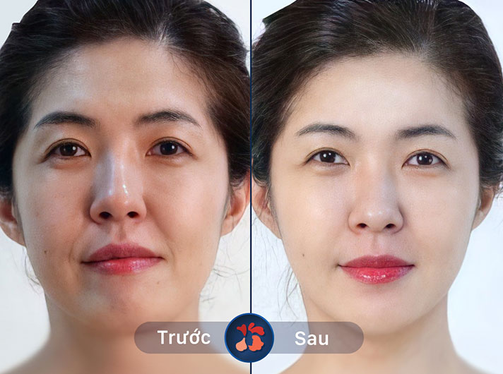 Ms.Lan Anh - Căng da không đau, hiệu quả nhanh chóng và rõ rệt