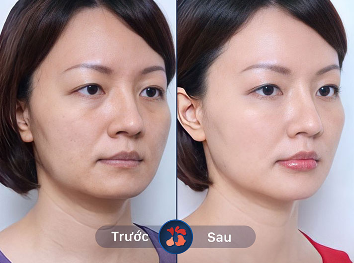 Ms.Trâm Anh - Quá trình thực hiện nhẹ nhàng và không hề đau đớn