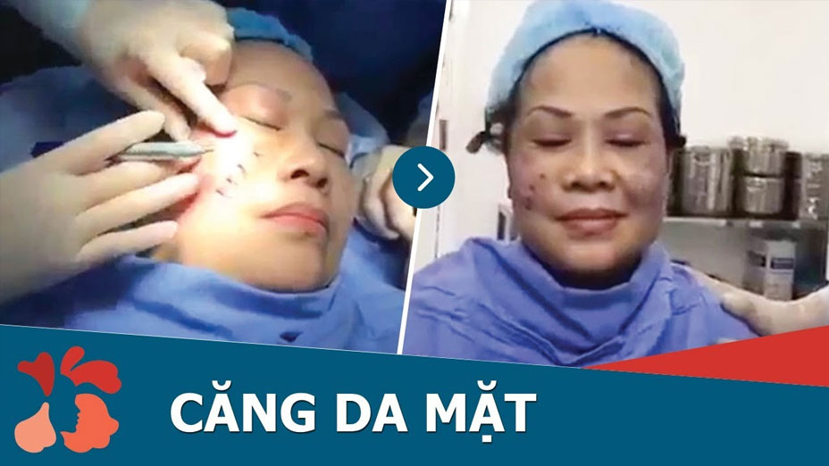 Kết quả Căng da chỉ - Trẻ hóa toàn diện không phẫu thuật