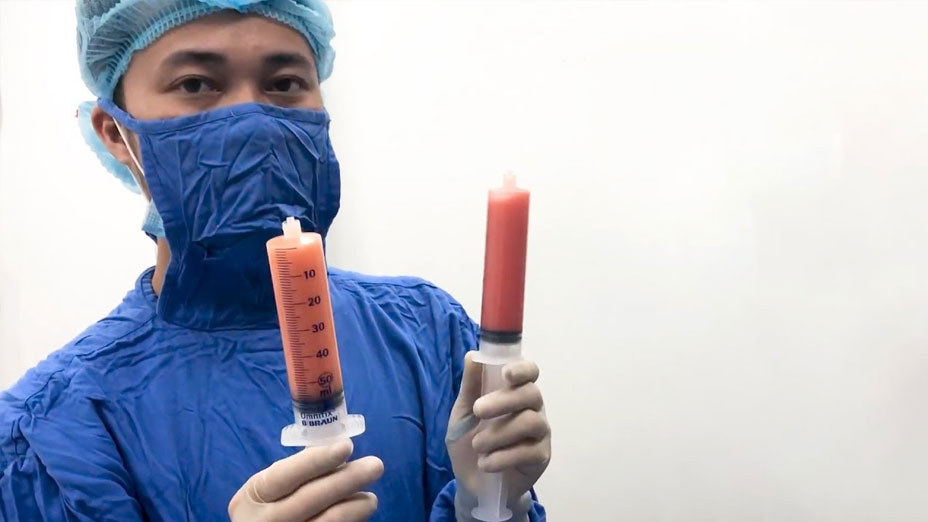 Quy trình lấy mỡ tự thân trước khi Cấy mỡ