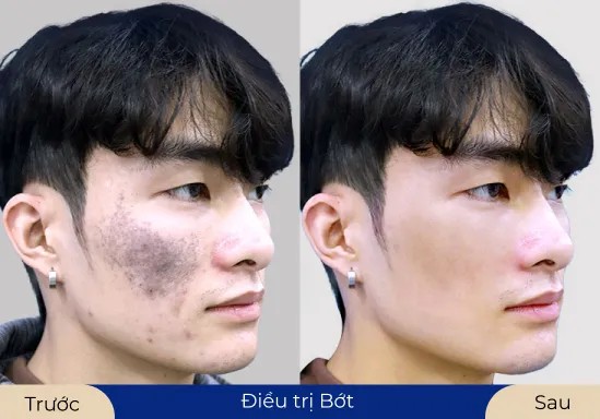 Mr.Thanh Tùng Làn da được tái sinh, mềm mịn nhờ dịch vụ điều trị bớt