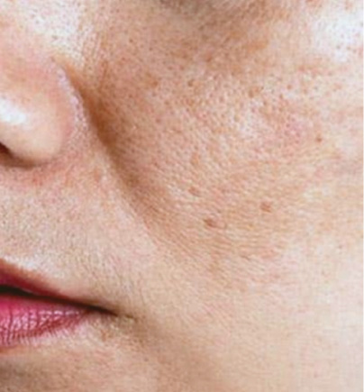 Trị nám tàng nhang