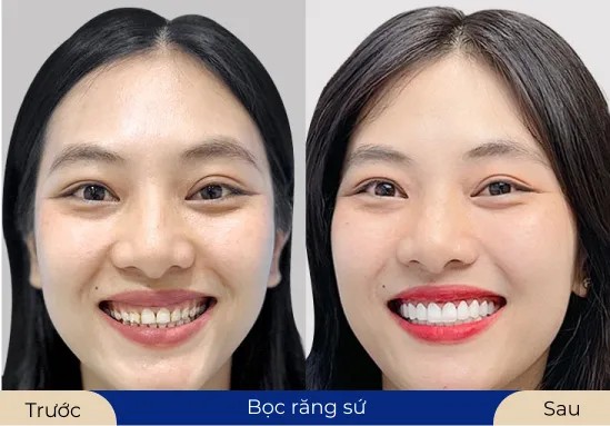 Ms.Thùy Dung Thực hiện bọc răng sứ giúp nụ cười tỏa sáng