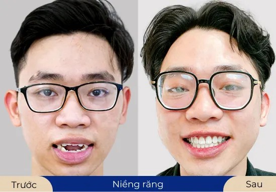 Mr.Trọng Hoàng Niềng răng giúp khách hàng cải thiện các khuyết điểm, mang đến gương mặt cân đối