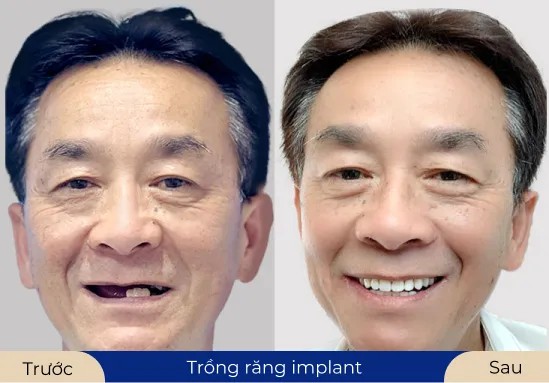 Mr.Đình Trọng Khách hàng lấy lại nụ cười rạng ngời với dịch vụ trồng răng Implant