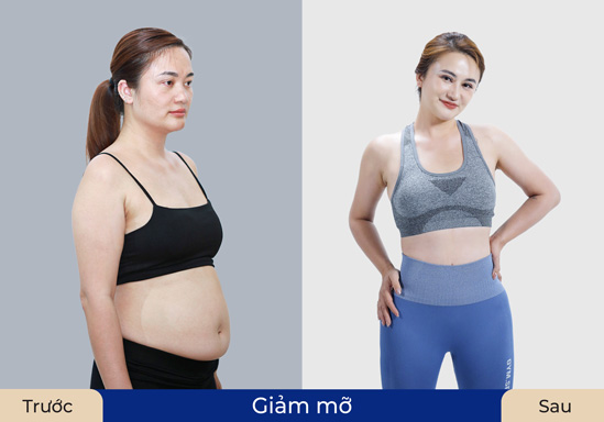 Khách hàng tự tin khoe vóc dáng sau khi sử dụng dịch vụ giảm mỡ