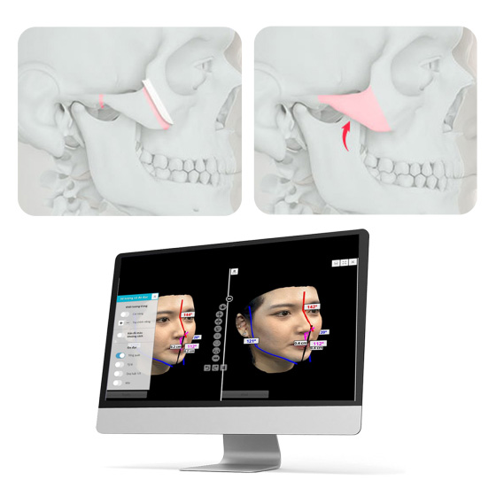 THU GỌN GÓC HÀM VLINE