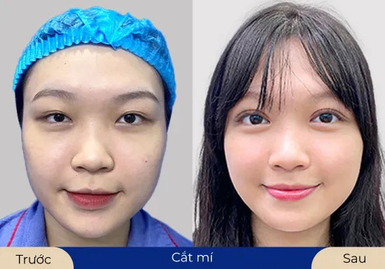 Ms.Bích Hằng Khách hàng sử dụng dịch vụ cắt mí