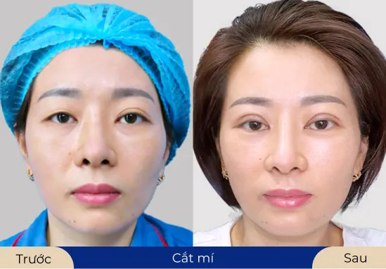 Ms.Thu Hà Kết quả ấn tượng khi sử dụng dịch vụ cắt mí