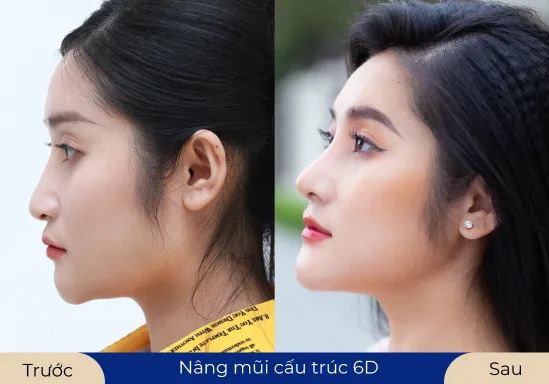 Ms.Bích Ngọc Làm mới vẻ đẹp với dịch vụ Nâng mũi cấu trúc 6D