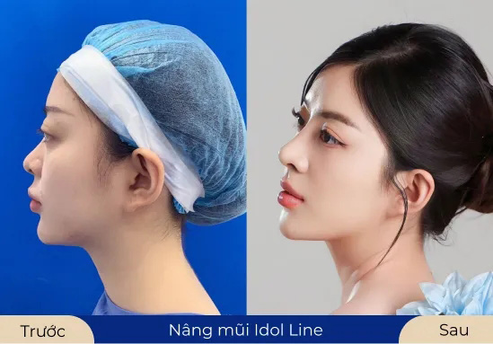 Ms.Phương Linh Thay đổi diện mạo với dịch vụ Nâng mũi Idol Line