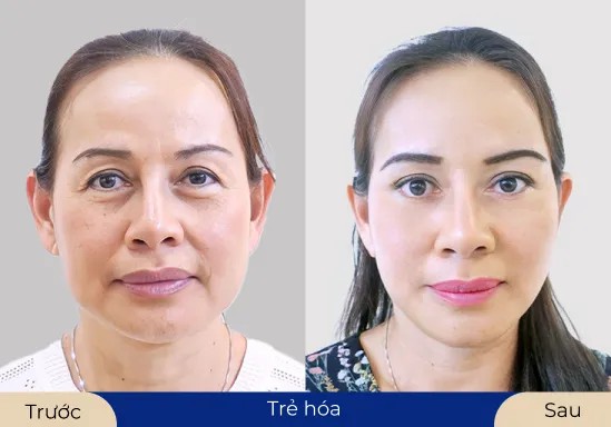 Ms.Thúy Nga Gương mặt căng bóng, mịn màng sau khi thực hiện dịch vụ trẻ hóa