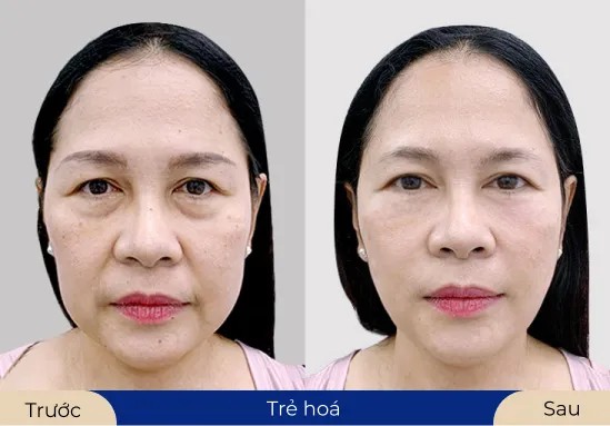 Ms.Thu Hằng Làn da trở nên mềm mịn hơn nhờ dịch vụ trẻ hóa