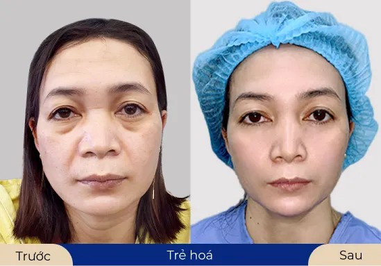 Ms.Thanh Thảo Dịch vụ trẻ hóa giúp da trở nên đều màu và có sự đàn hồi hơn