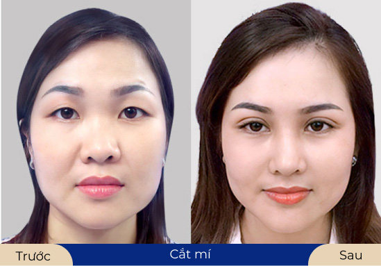 Ms.Thuỳ Chi Khách hàng hài lòng khi sử dụng dịch vụ cắt mí