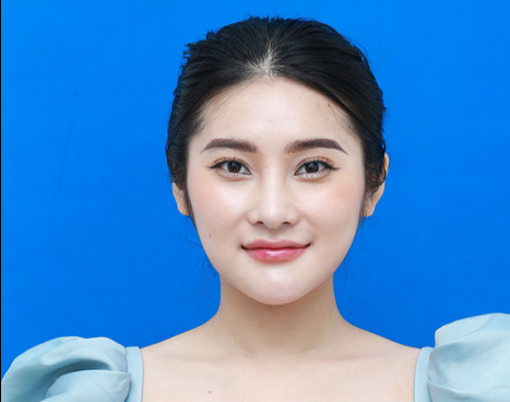 Ước mơ sở hữu dáng mũi cao tây của Hồng Anh đã thành hiện thực