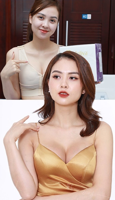 Thay đổi ngoạn mục sau khi nâng ngực