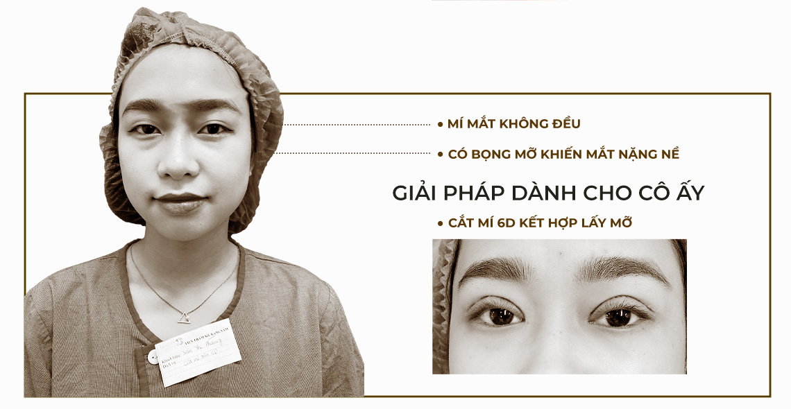 Giải pháp cắt mí 6D kết hợp lấy mỡ