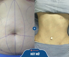 khách hàng hút mỡ tại kangnam