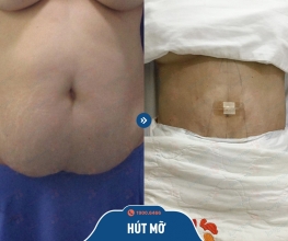 kết quả hút mỡ nhanh kangnam