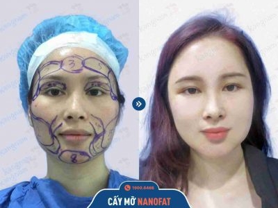 kết quả cấy mỡ mặt ở kangnam