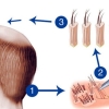 Cấy tóc tự thân – Giải pháp số 1 khắc phục tóc mỏng thưa, hói tóc bẩm sinh
