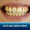 16 cách làm trắng răng an toàn, khắc phục răng ố vàng, xỉn màu!