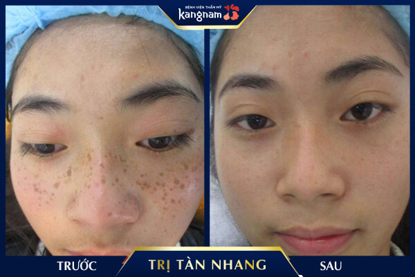 Điều trị tàn nhang Laser Picosure