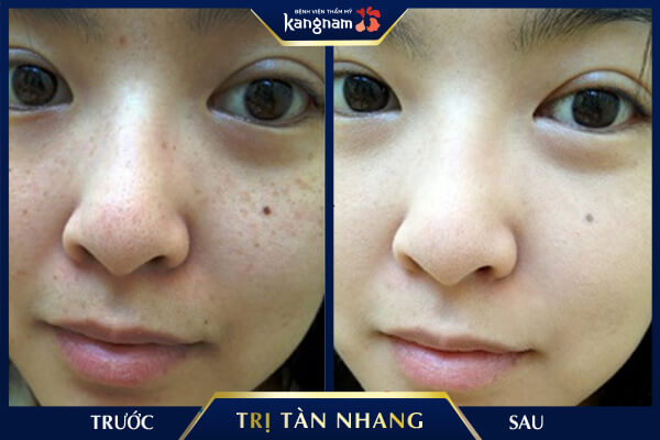 điều trị tàn nhang Laser Picosure
