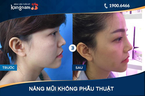 Nâng mũi không phẫu thuật/tiêm Filler phù hợp với nhứng người có ít khuyết điểm mũi nâng mũi không phẫu thuật