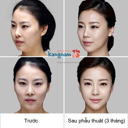 Phẫu thuật Hạ Gò Má 3D Hàn Quốc: Mặt cân đối, hết 