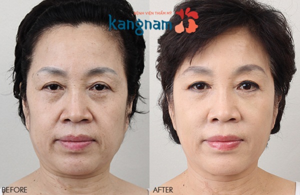 Kết quả căng da mặt bằng chỉ tại BVTM Kangnam