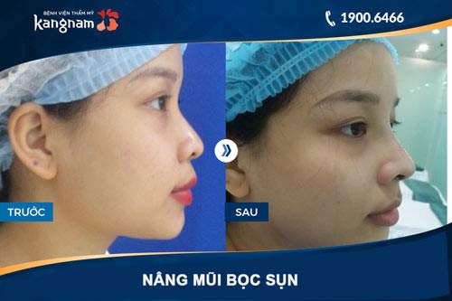 Đầu mũi tròn, cong nhẹ, không có dấu vết thẩm mỹ hay bóng đỏ hình ảnh nâng mũi bọc sụn