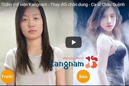 Hành trình lột xác của Châu Quỳnh nâng mũi Sline 4D 786