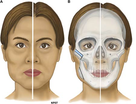 Phẫu thuật hạ gò má 3D 1