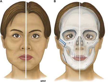 Phẫu thuật hạ gò má 3D có ưu điểm gì Phẫu thuật hạ gò má 3D 1