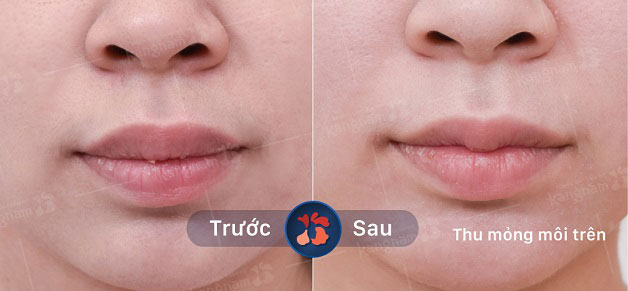 Kết quả trước và sau khi thu mỏng môi 