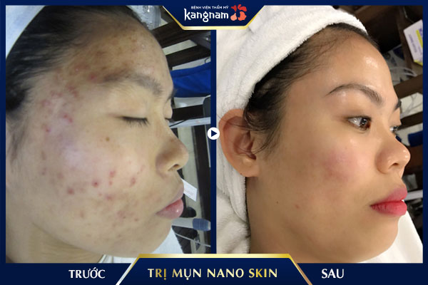 Toàn bộ mụn bọc lâu năm đã biến mất hoàn toàn sau 5 buổi điều trị mụn công nghệ Nano Skin